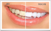 White Light - домашнее отбеливание зубов